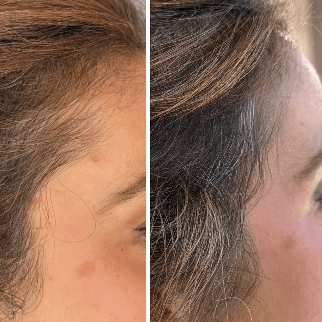 Before and after hair growth results showing thicker, fuller hair after consistent LED light therapy treatments.