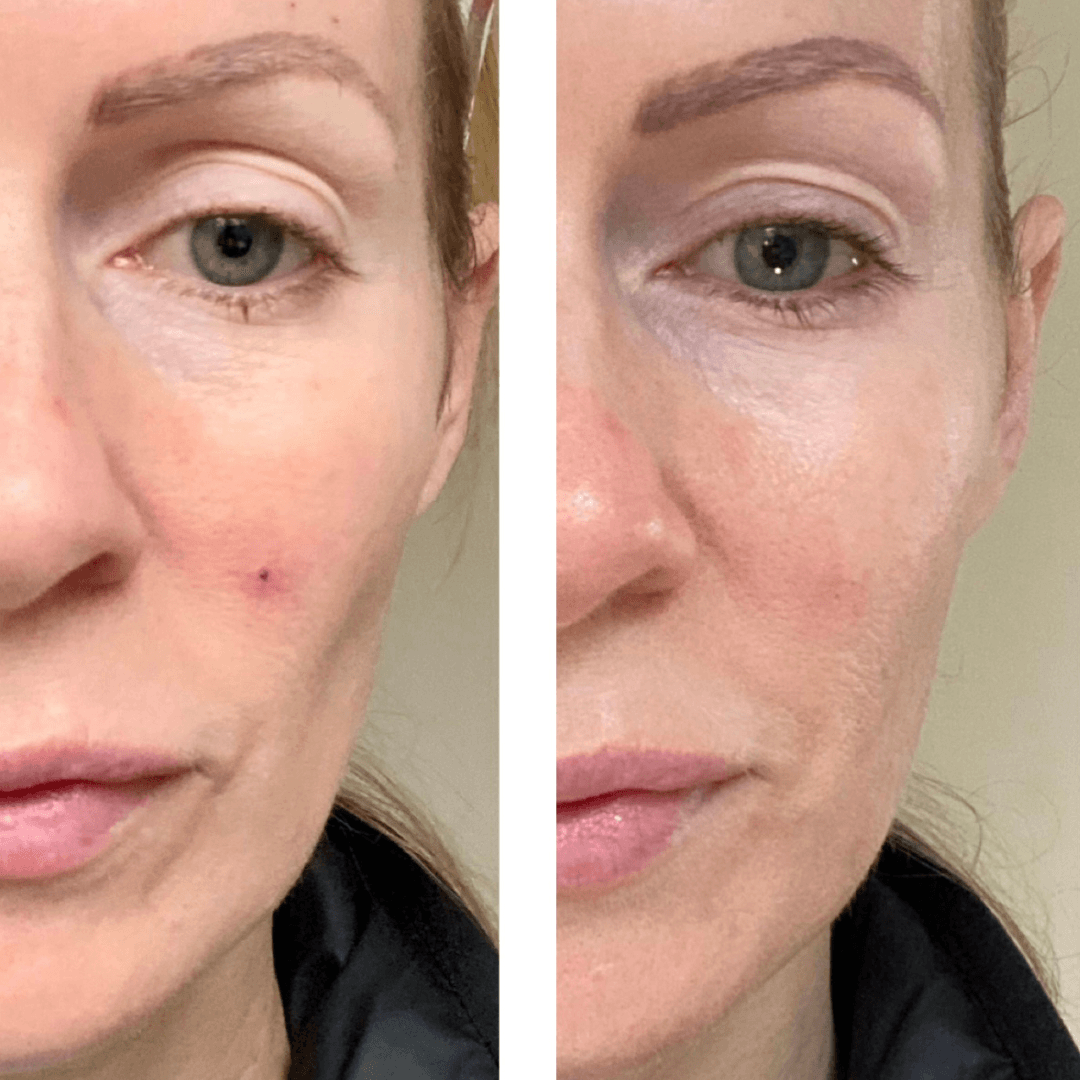 Before and after comparison showing skin improvement using LED skin rejuvenation mask bundle.