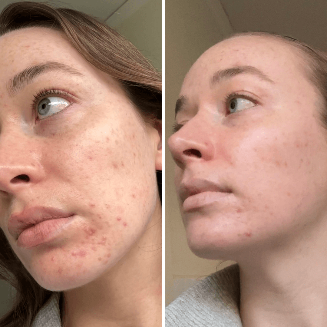 Before and after using the Glow LED Face Mask for acne treatment, showing reduced breakouts on the skin.