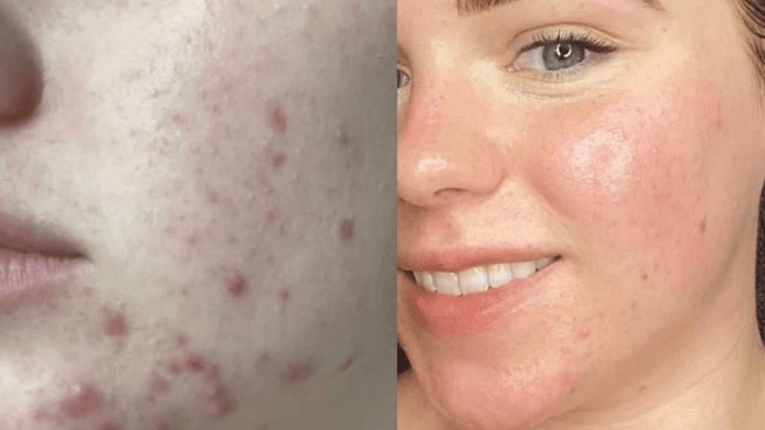 Acne before and after
