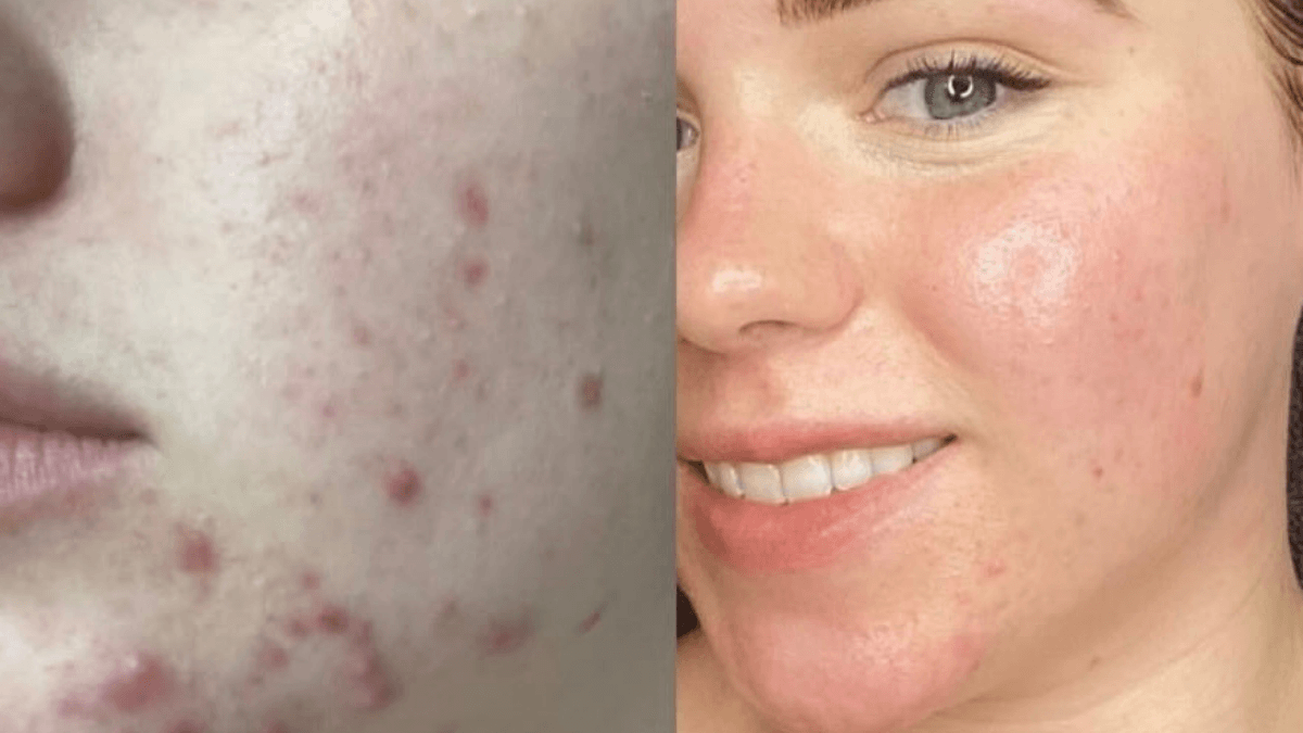 Acne before and after