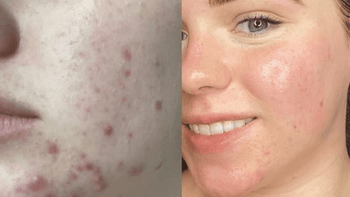 Acne before and after