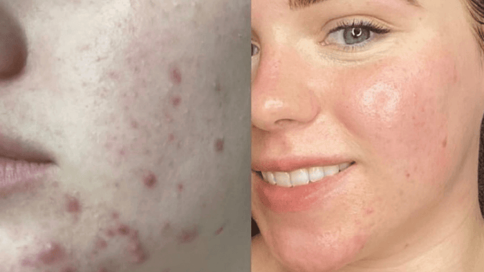 Acne before and after