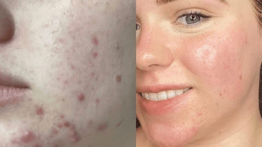 LED Light Therapy for Acne: A Non-Invasive Solution