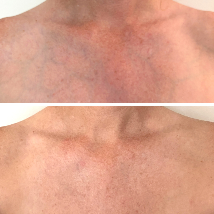 A before-and-after split comparison of a person's chest skin, showing a reduction in redness and inflammation in the bottom photo.