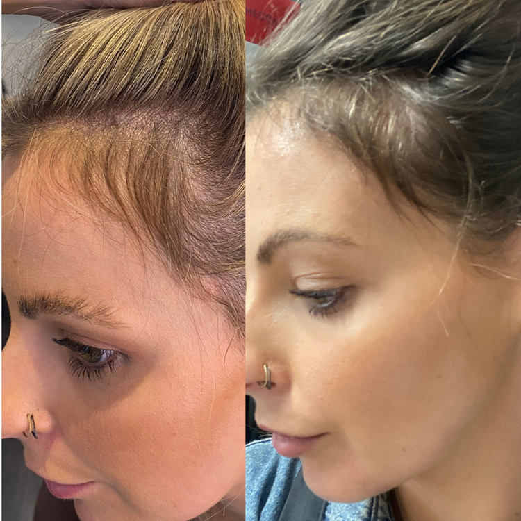 Trudermal Halo hair growth helmet helps stimulate the hair follicles and improve scalp health.