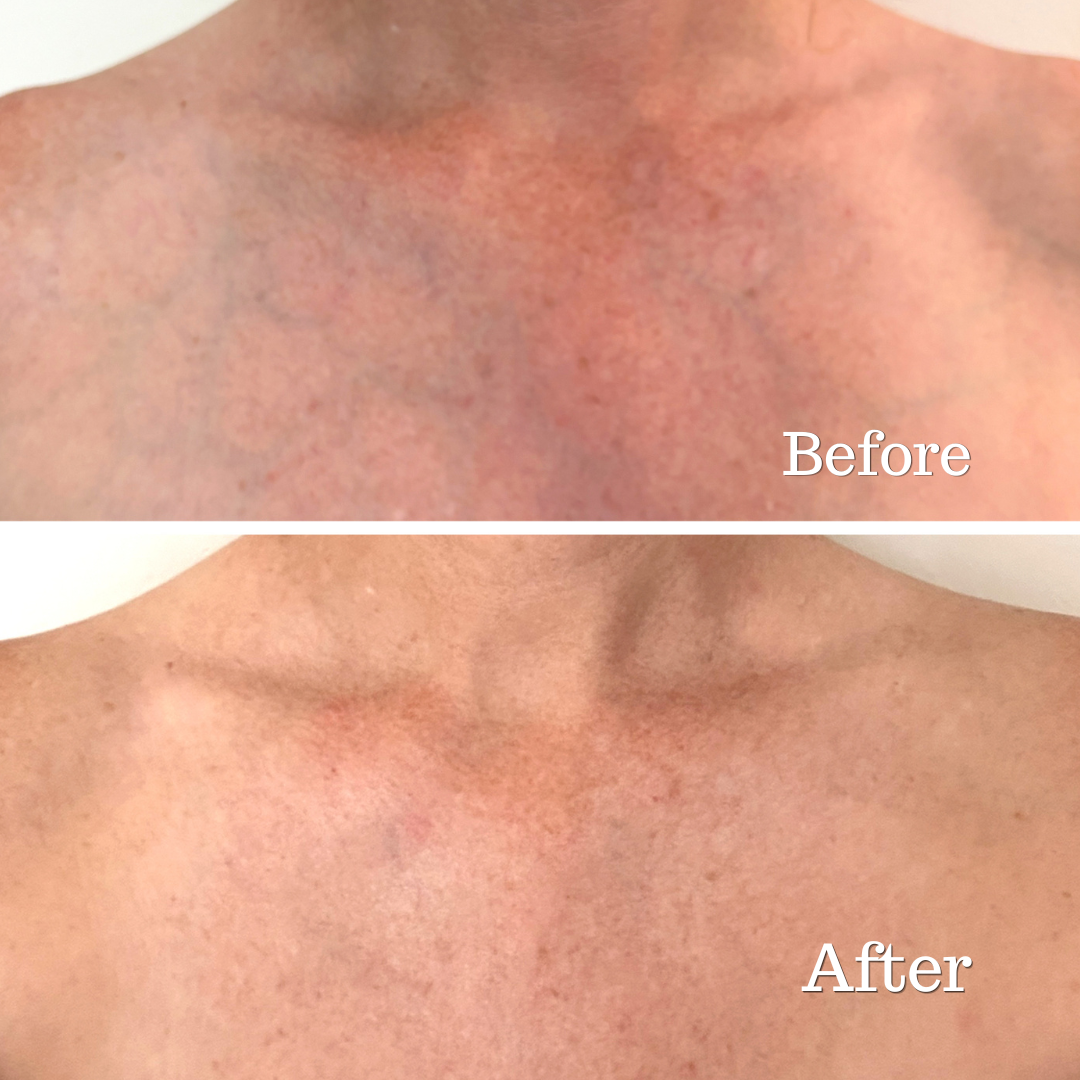 Before and after neck