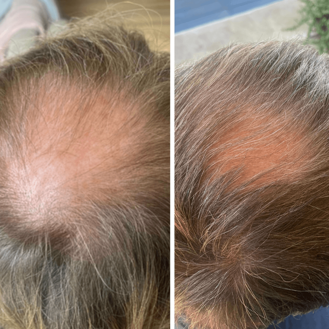 Before and after hair growth