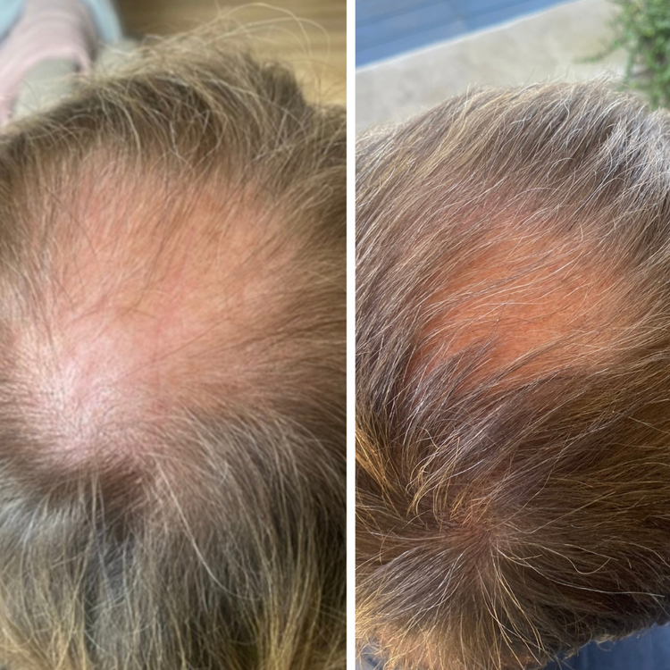 Before and after results showing improved hair growth and density after using LED light therapy for hair follicle stimulation.