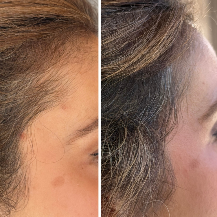 Before and after hair growth results showing thicker, fuller hair after consistent LED light therapy treatments.