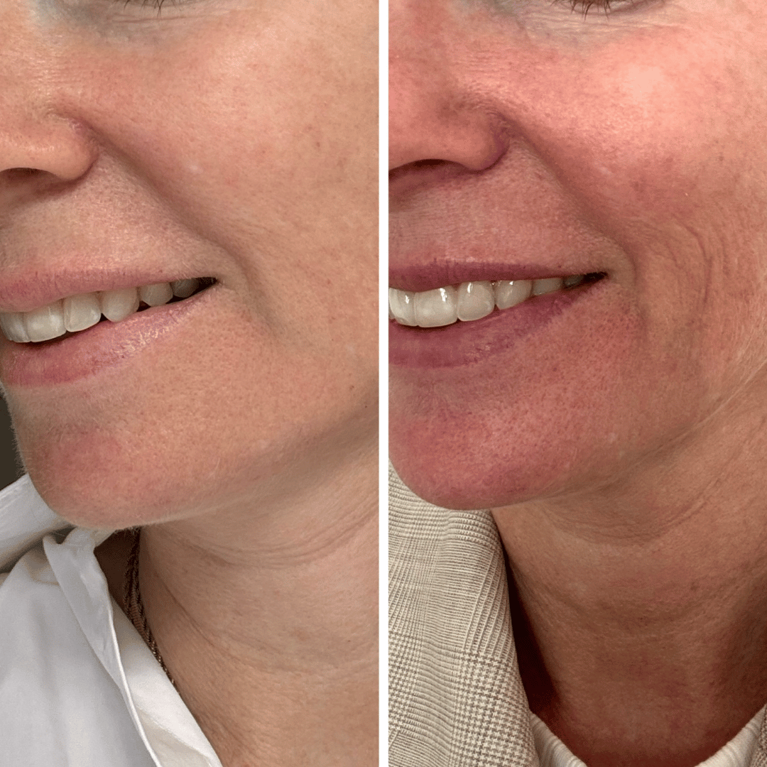 Before and after skin results
