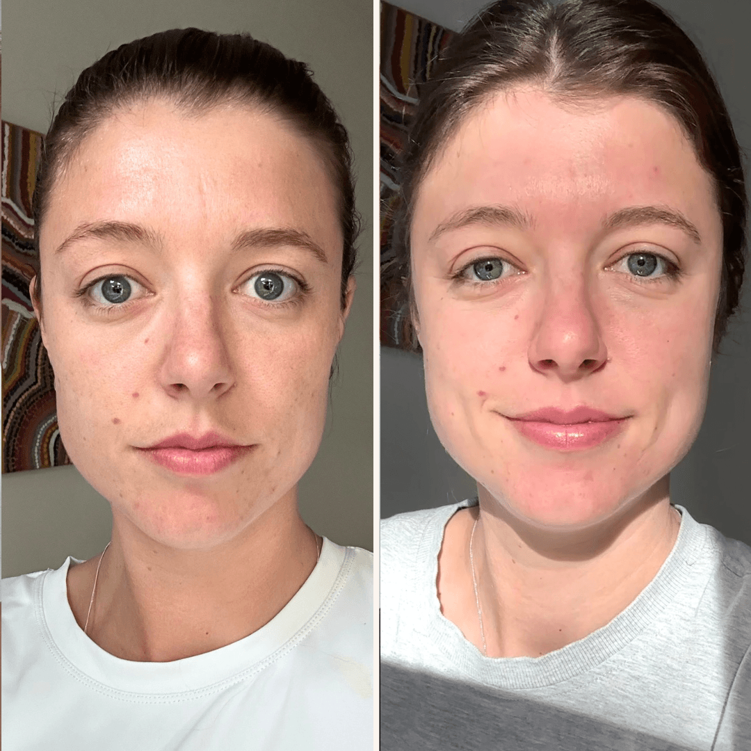 Before and after skin transformation