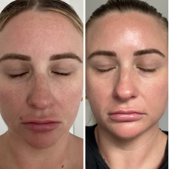 Microneedling Infusion Kit